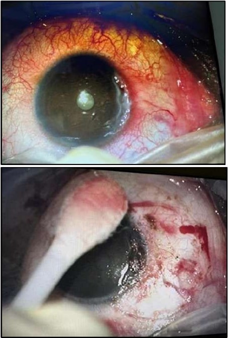 Journal of Ophthalmic Science - Conjunctival Resection