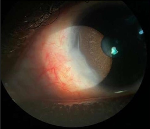 Journal of Ophthalmic Science - Conjunctival Resection