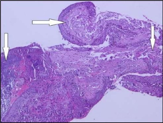 Journal of Ophthalmic Science - Conjunctival Resection