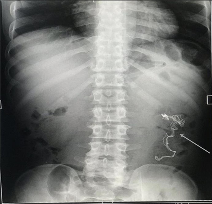 Journal of Clinical Case Reports and Images - Retained Surgical Sponge