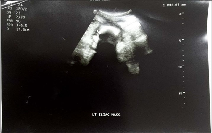 Journal of Clinical Case Reports and Images - Retained Surgical Sponge