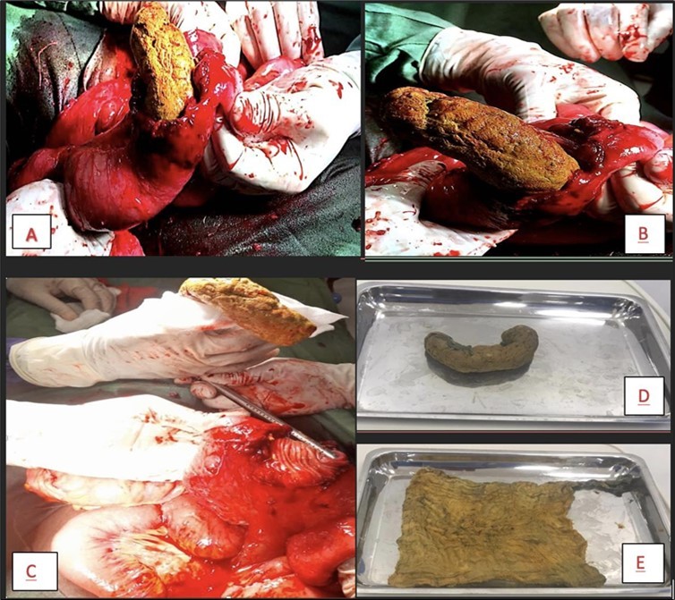 Journal of Clinical Case Reports and Images - Retained Surgical Sponge