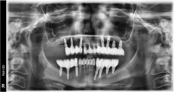 Journal of Dentistry and Oral Implants - Periimplantitis