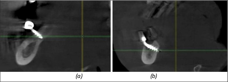 Journal of Dentistry and Oral Implants - Periimplantitis