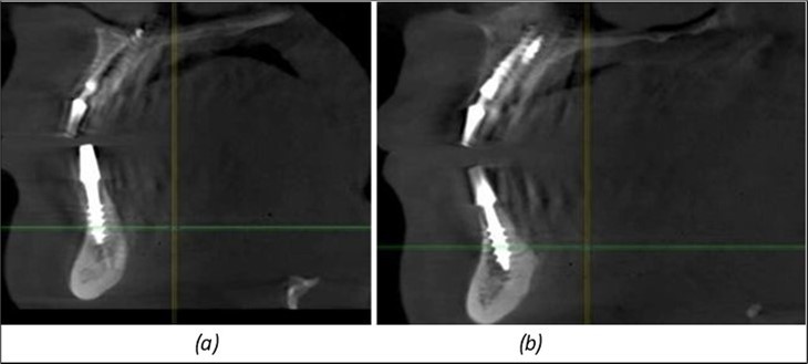 Journal of Dentistry and Oral Implants - Periimplantitis