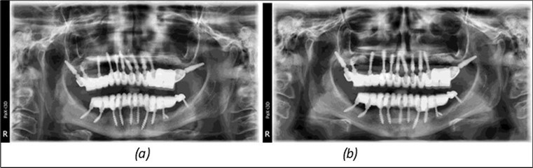 Journal of Dentistry and Oral Implants - Periimplantitis