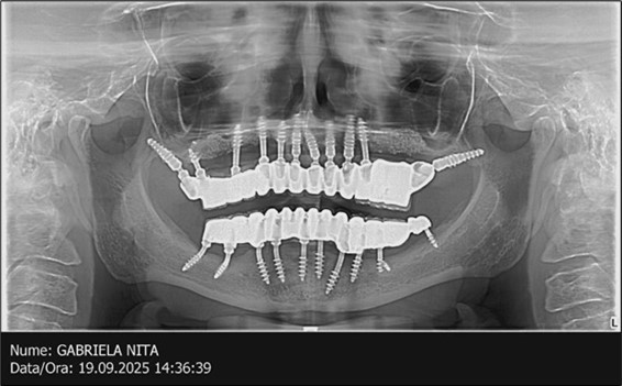 Journal of Dentistry and Oral Implants - Periimplantitis