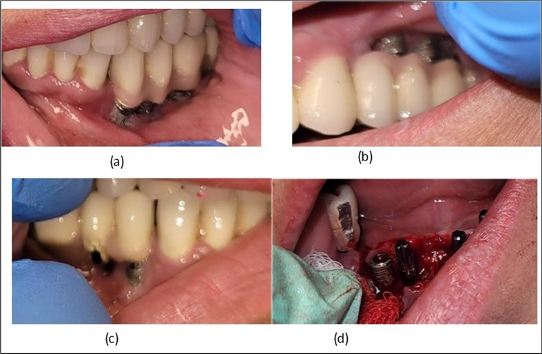 Journal of Dentistry and Oral Implants - Periimplantitis
