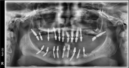 Journal of Dentistry and Oral Implants - Periimplantitis