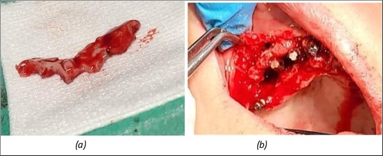 Journal of Dentistry and Oral Implants - Periimplantitis
