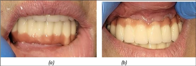 Journal of Dentistry and Oral Implants - Periimplantitis