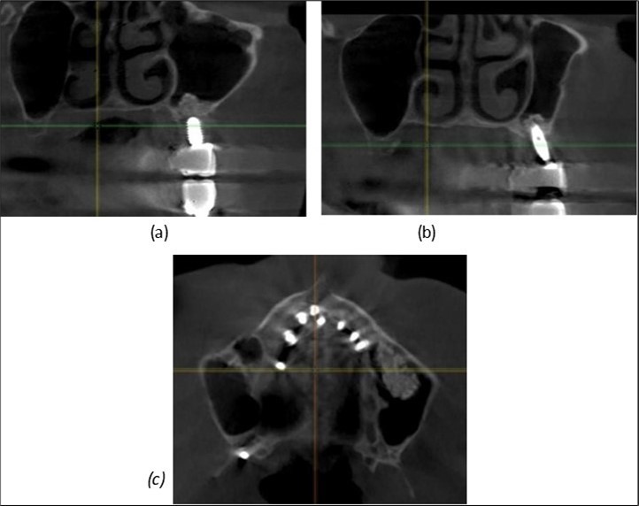 Journal of Dentistry and Oral Implants - Periimplantitis