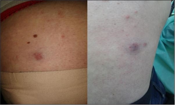 Journal of Dermatologic Research and Therapy-Pernio