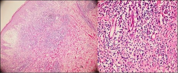 Journal of Dermatologic Research and Therapy-Pernio