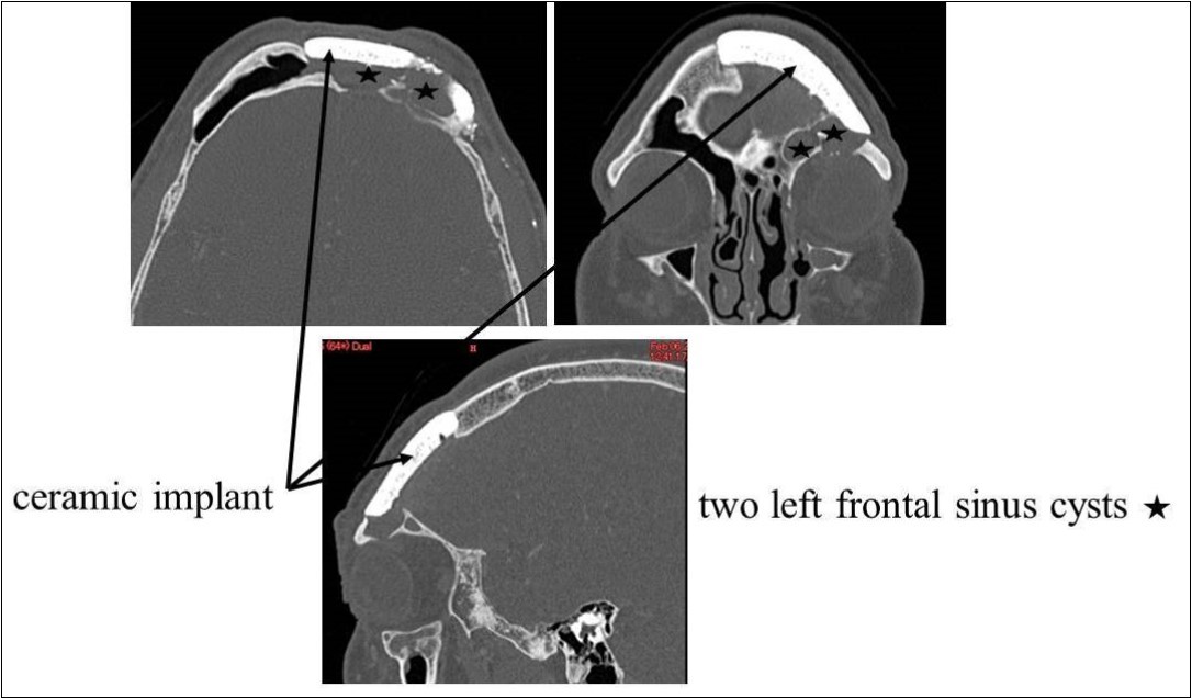 Journal of Otolaryngology Advances-CT