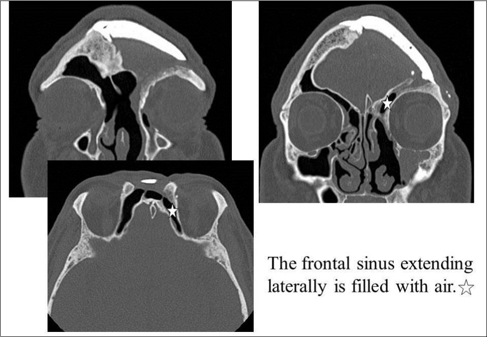 Journal of Otolaryngology Advances-CT