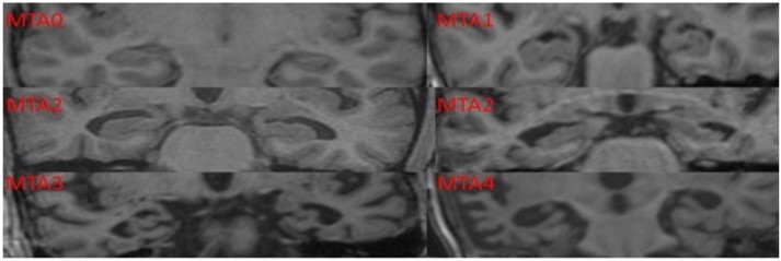 Journal of Depression and Therapy-Serum Cortisol