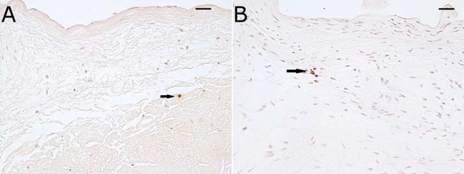 Journal of Hypertension and Cardiology-mitral valve