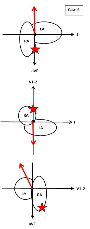 Journal Of Hypertension And Cardiology-Ablation
