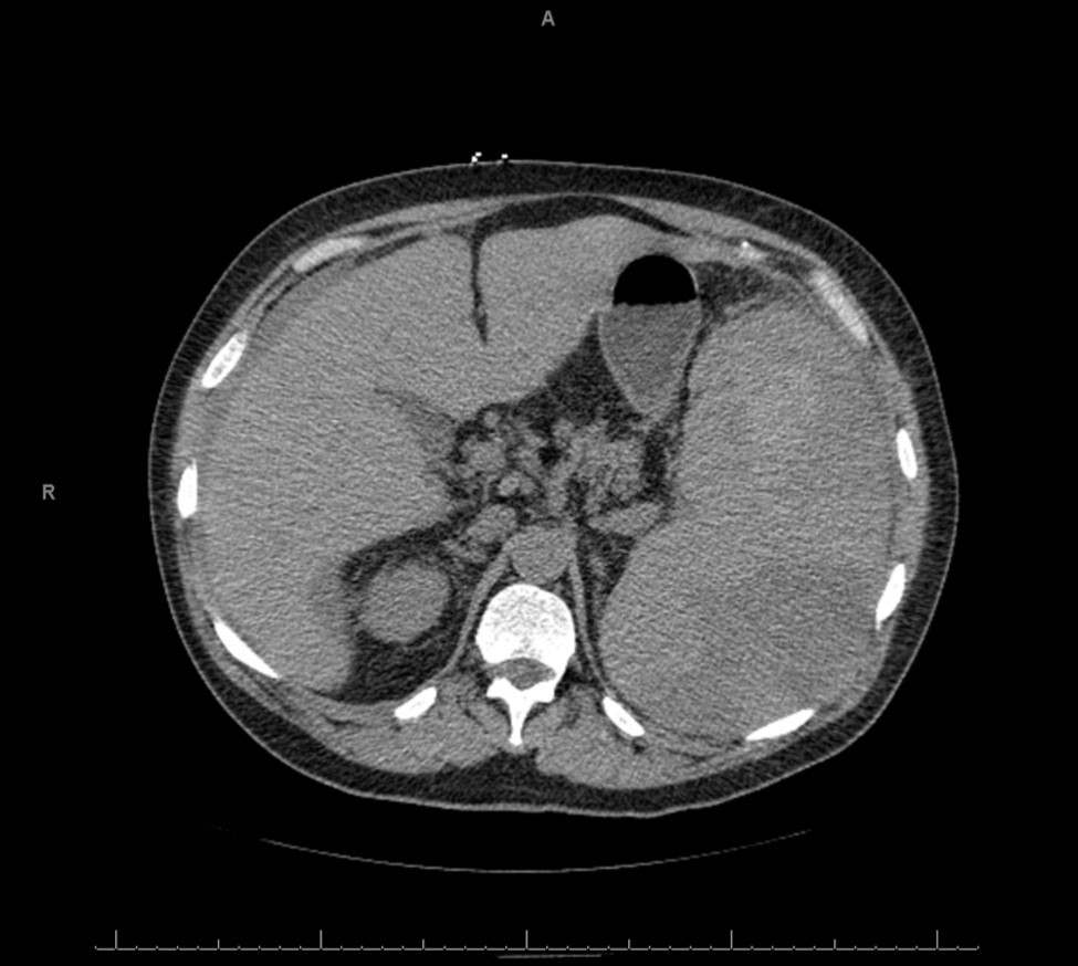 Journal of Spleen And Liver Research-chronic cough
