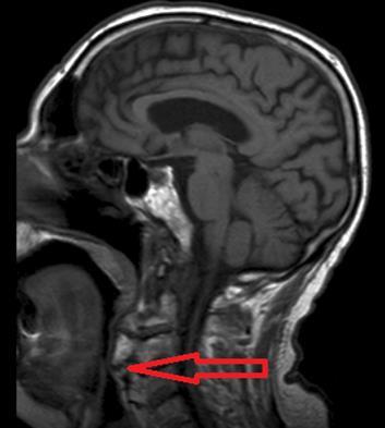 Journal Of Sleep And Sleep Disorder Research-sleep-apnea