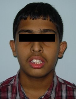 Journal of Dentistry And Oral Implants-bilateral maxillary posterior cross-bite