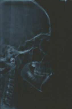 Journal of Dentistry And Oral Implants-bilateral maxillary posterior cross-bite