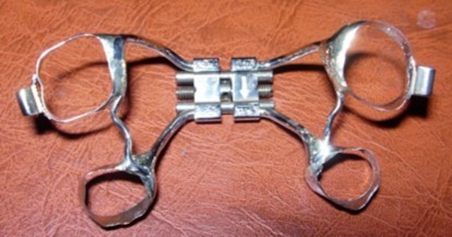 Journal of Dentistry And Oral Implants-bilateral maxillary posterior cross-bite