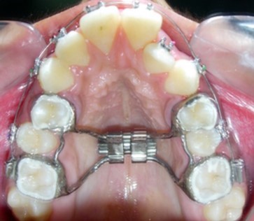 Journal of Dentistry And Oral Implants-bilateral maxillary posterior cross-bite