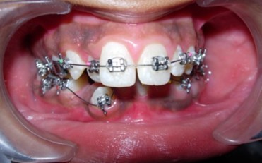 Journal of Dentistry And Oral Implants-bilateral maxillary posterior cross-bite
