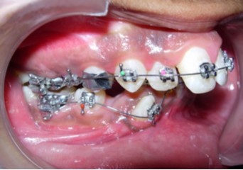Journal of Dentistry And Oral Implants-bilateral maxillary posterior cross-bite