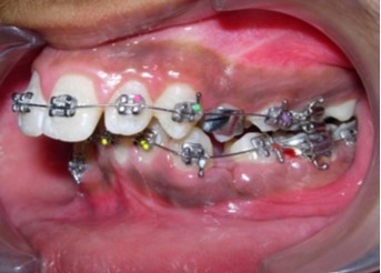 Journal of Dentistry And Oral Implants-bilateral maxillary posterior cross-bite