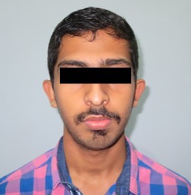 Journal of Dentistry And Oral Implants-bilateral maxillary posterior cross-bite