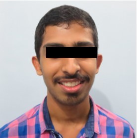 Journal of Dentistry And Oral Implants-bilateral maxillary posterior cross-bite