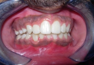 Journal of Dentistry And Oral Implants-bilateral maxillary posterior cross-bite