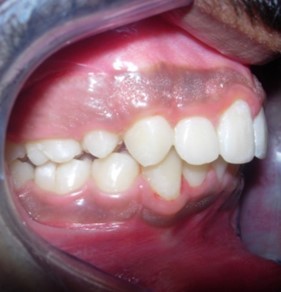 Journal of Dentistry And Oral Implants-bilateral maxillary posterior cross-bite