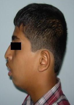 Journal of Dentistry And Oral Implants-bilateral maxillary posterior cross-bite