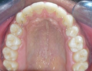 Journal of Dentistry And Oral Implants-bilateral maxillary posterior cross-bite