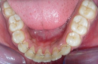 Journal of Dentistry And Oral Implants-bilateral maxillary posterior cross-bite
