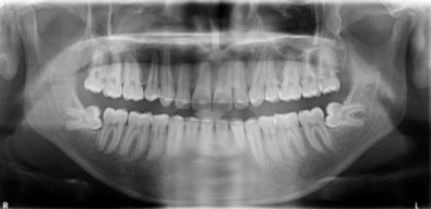 Journal of Dentistry And Oral Implants-bilateral maxillary posterior cross-bite