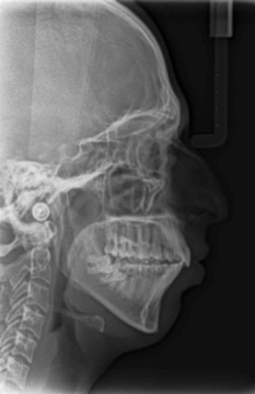 Journal of Dentistry And Oral Implants-bilateral maxillary posterior cross-bite