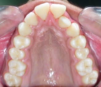 Journal of Dentistry And Oral Implants-bilateral maxillary posterior cross-bite