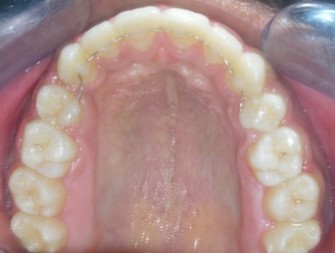Journal of Dentistry And Oral Implants-bilateral maxillary posterior cross-bite