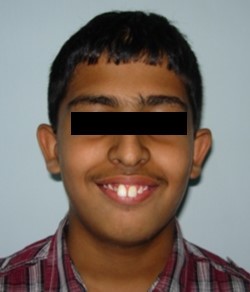 Journal of Dentistry And Oral Implants-bilateral maxillary posterior cross-bite