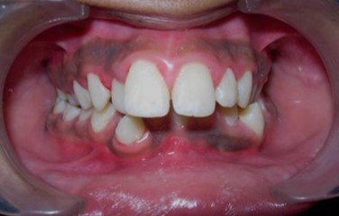 Journal of Dentistry And Oral Implants-bilateral maxillary posterior cross-bite