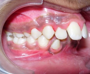 Journal of Dentistry And Oral Implants-bilateral maxillary posterior cross-bite
