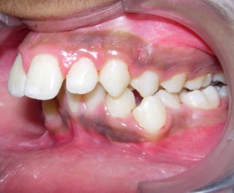 Journal of Dentistry And Oral Implants-bilateral maxillary posterior cross-bite