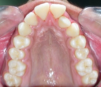 Journal of Dentistry And Oral Implants-bilateral maxillary posterior cross-bite