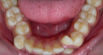 Journal of Dentistry And Oral Implants-bilateral maxillary posterior cross-bite