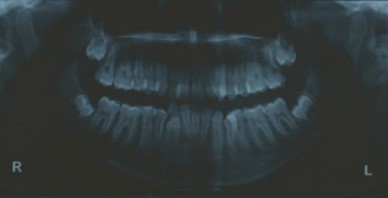 Journal of Dentistry And Oral Implants-bilateral maxillary posterior cross-bite